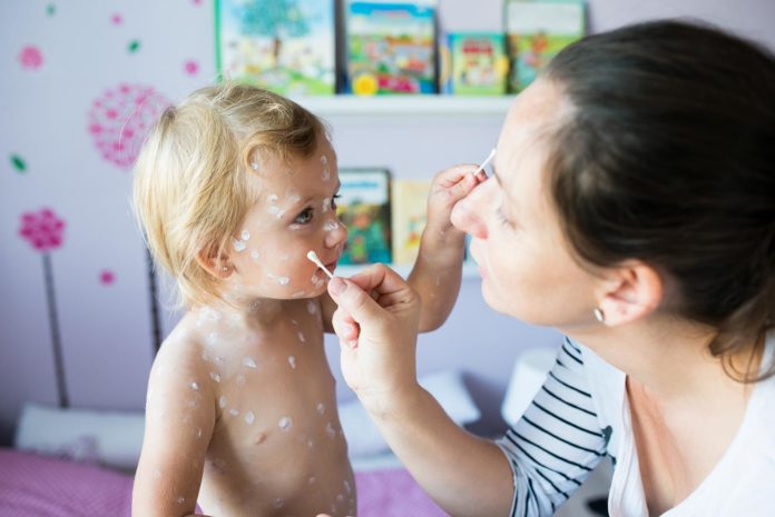 girl-with-chickenpox-antiseptic-cream-applied-to-P52RZZ2 Infections
